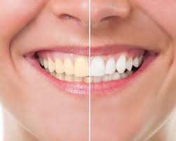 Teeth Whitening Treatments – What Are Your Options?