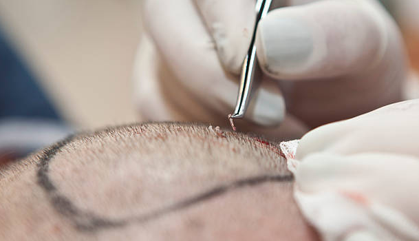 Best hair transplant treatment for bald men in Pune